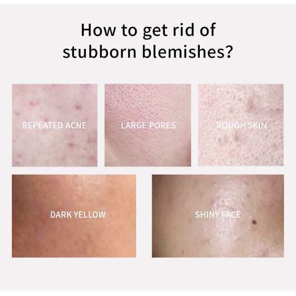 Suero facial OEM para el cuidado de la piel con ácido salicílico, suero en gel para tratamiento de manchas, dermatólogo, 30 ml