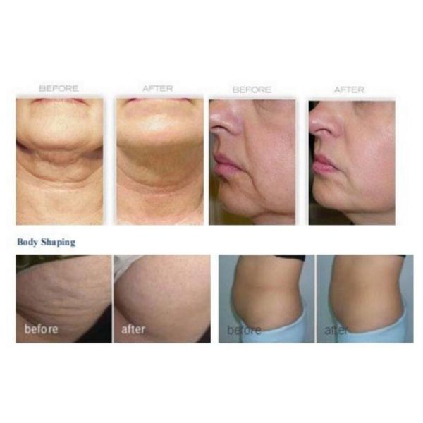 Non-Invasive Body Care INDIBA Proionic System: Reduce Wrinkles, Stretch Marks & Localised Fat Burning & Face Lifting