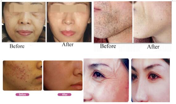 10Hz E Light Beauty Equipment