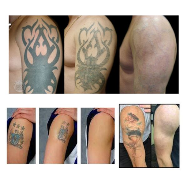 Long Pulsed Nd Yag Laser Tattoo Removal Machine ,  Clinic Tattoo Eraser Machine