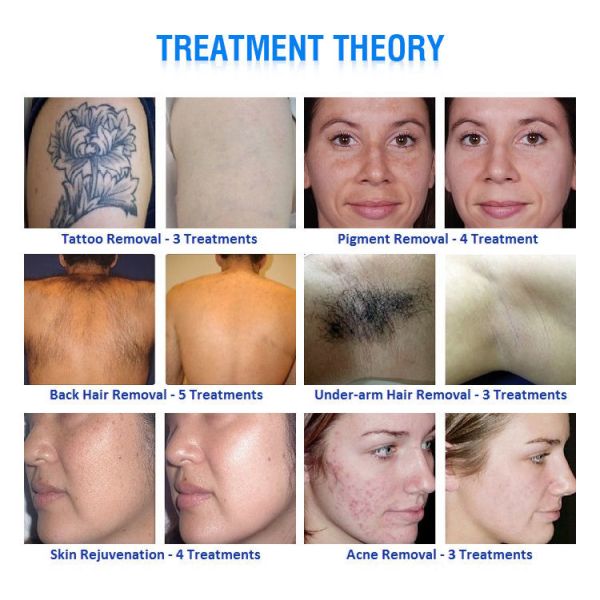 640nm 530nm 480nm IPL Laser Hair Removal Machine SHR OPT Elight Machine