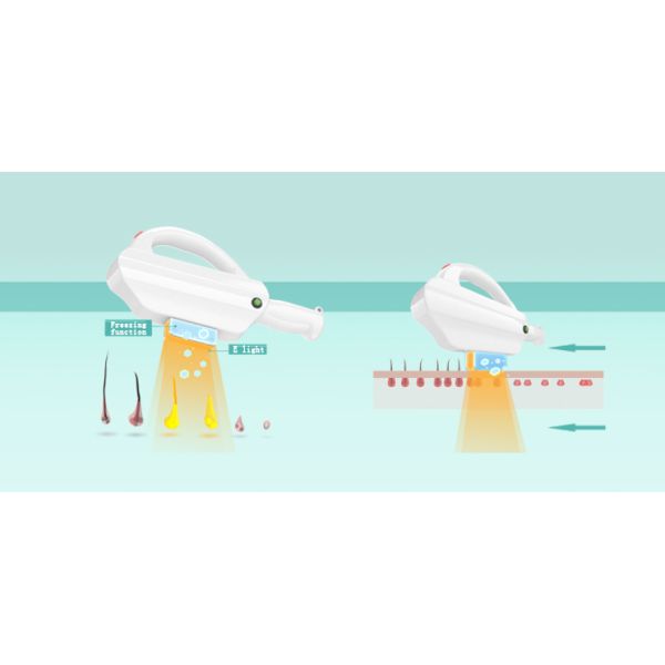 Painless super laser hair removal & skin rejuvenation machine SHR+IPL