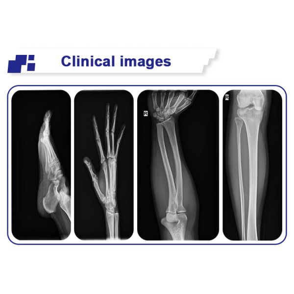 Мобильный портативный экран рентгенографии оборудования цифров кс Рэй диагноз 100мА ЛКД