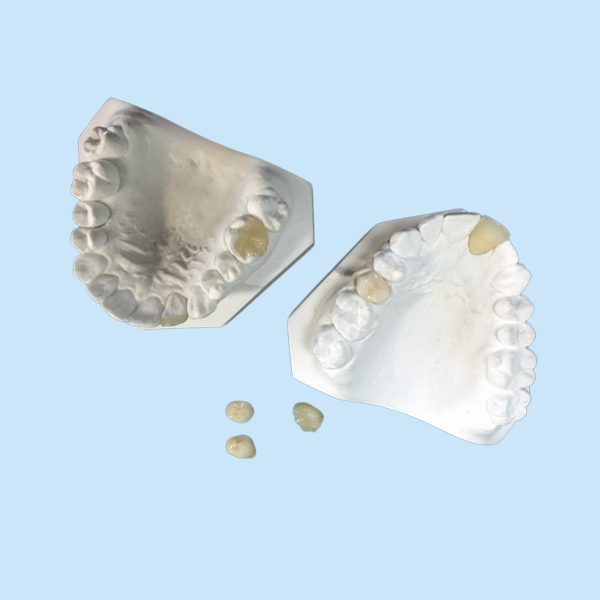 Легкий поддерживайте Onlay инкрустации облицовки кроны OEM белый керамический зубоврачебный