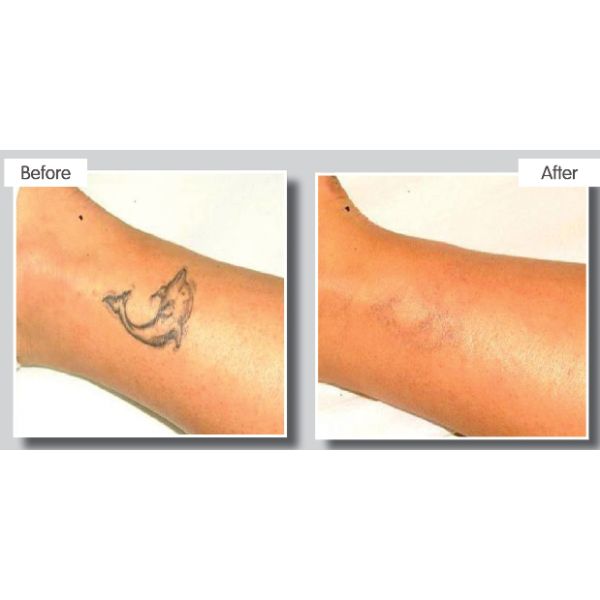 Mini Pico Laser Portable Laser Tattoo Removal Machine With Ce Approved