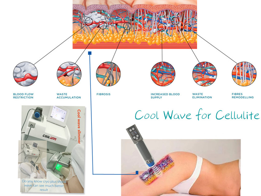 Мобильная машина Cryolipolysis жирная замерзая для размера потери веса компактного