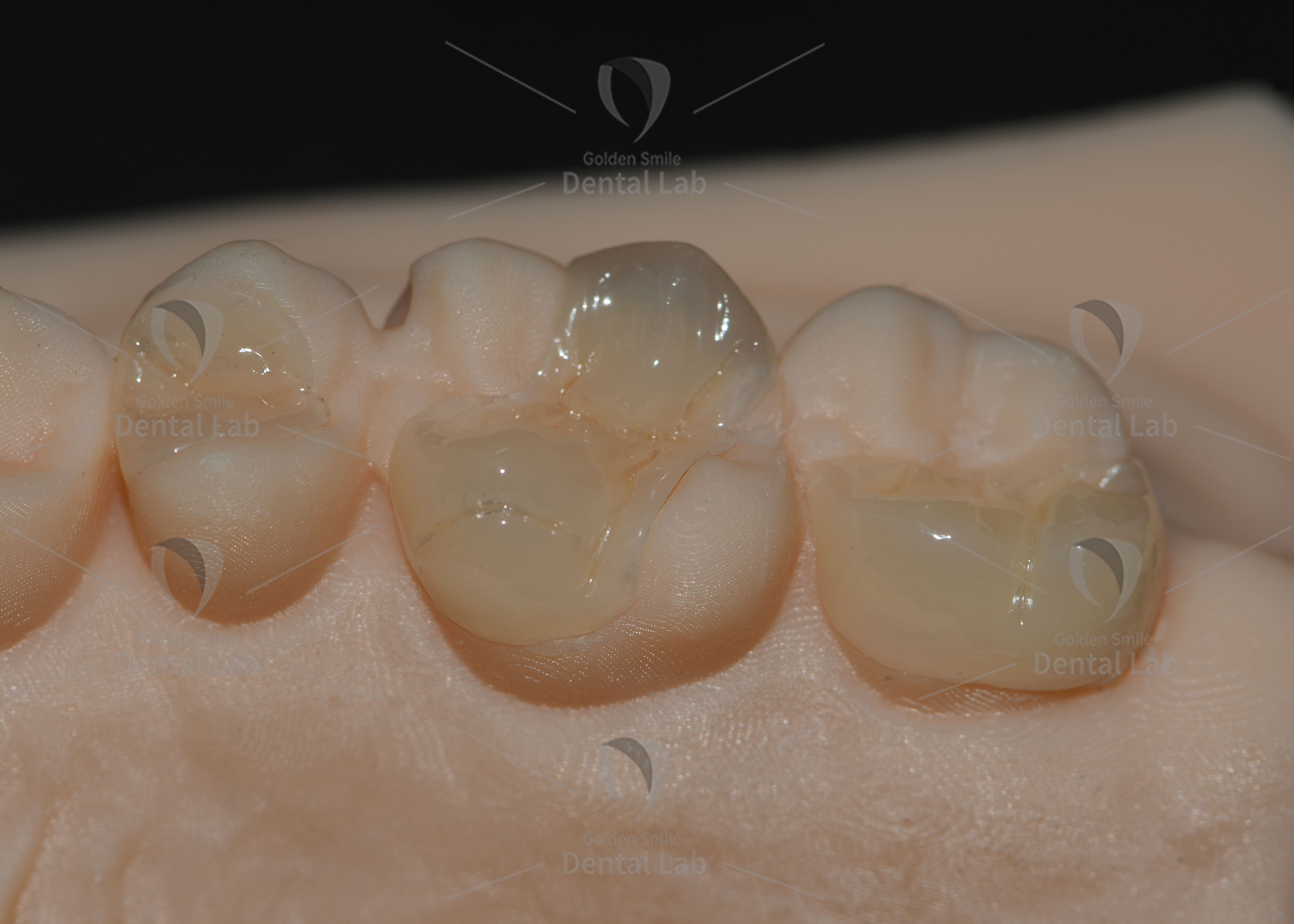Biocompatible Lithium Disilicate Pressed Ceramic Inlays with Natural Aesthetics for Minimally-invasive Dental Restoration