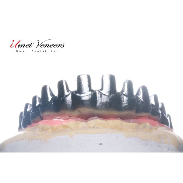 Biocompatible Titanium Marlow Bridge