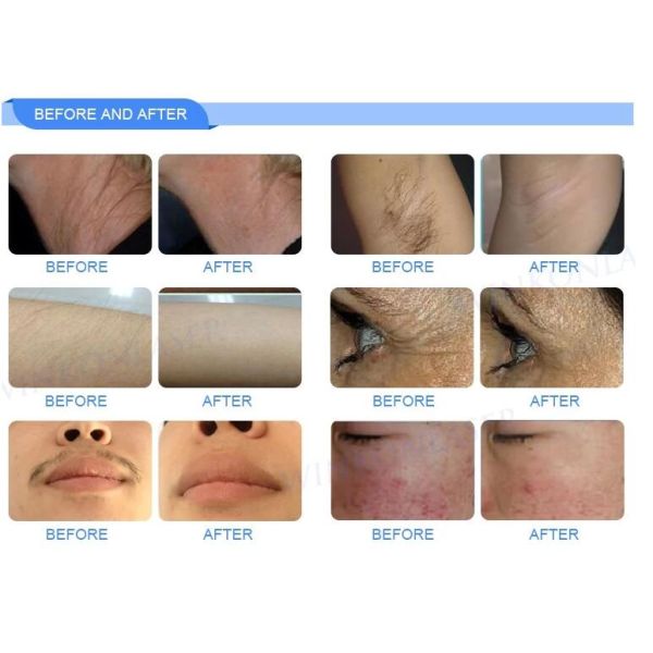 3000W High Power IPL OPT SHR Hair Removal Equipment Two Handles Type