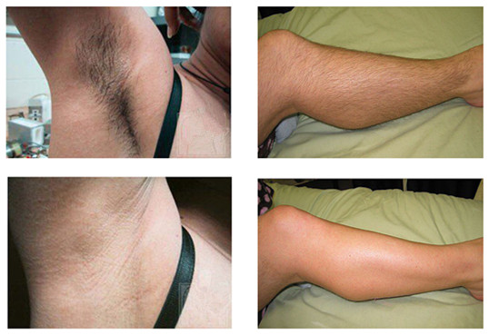 Triple Wavelengths Diode Laser Hair Removal Machine With 755nm, 808nm, 1064nm