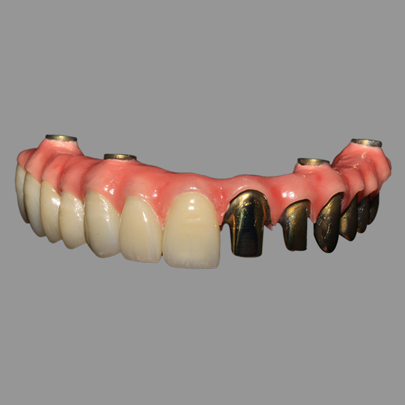 Dental Implant Lab | Class 2 Hybrid Malong Full Arch AOX Implant Bridge Titanium Bar With Full Solid Zirconia