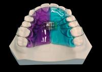 Expansor amovible pour un traitement orthodontique efficace et une amélioration du sourire