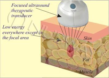 Ultrasound for weight loss / hifu ultrasound lipo slimming machine
