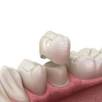 Curado duro resistente de la circona del OEM de la grieta única dental natural de la corona