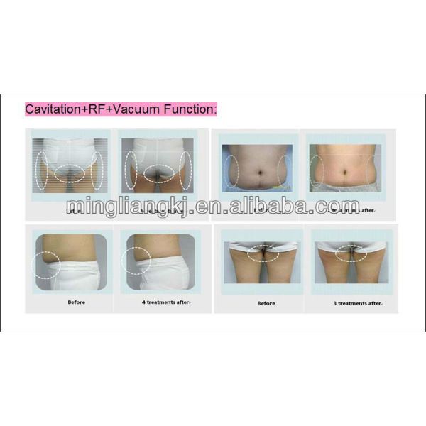 Tripolar RF 40KHZ Cavitation Cryolipolysis Slimming Machine / Device For Beauty Skin SPA