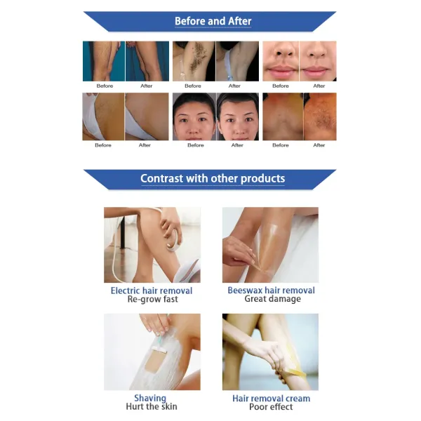 Máquina de depilación láser de diodo 808nm RL-808B 2000W