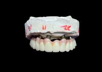 Implantation dentaire, prothèses dentitaires fixes à arc complet pour une solution permanente, stable et naturelle aux dents manquantes