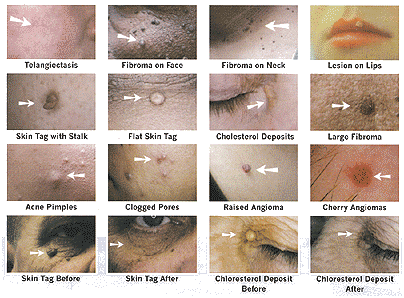 Effective 30Mhz high frequency spider vein removal Facial Vein Clearance Machine