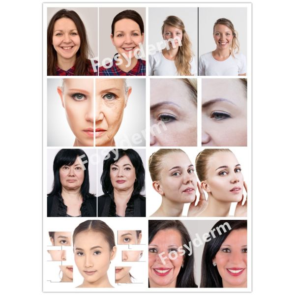 BOTOX впрыснуто для того чтобы улучшить морщинки стороны в типе a взрослых 100IU