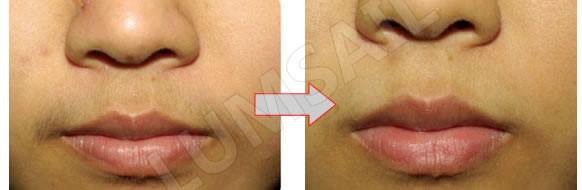 SHR System IPL Permanent Hair Removal Machine For Unwanted Hair Removal