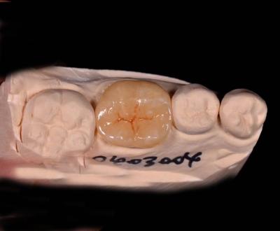 Custom Made Indirect And Porcelain Inlays And Onlays With Dental Overlays