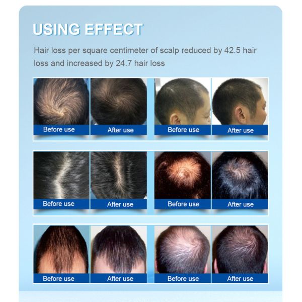 650nm Laser Helmet For Baldness Prevent Treatment Thicker Hair Regrowth