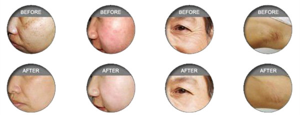 3000W SHR Skin Rejuvenation Beauty Equipment Machine For Speckle , Wrinkle Removal