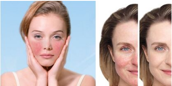 Diode Laser Vascular Treatment Spider Vein Removal Machine 30A