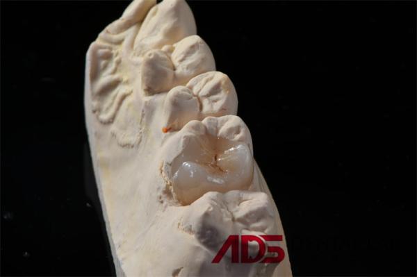 Natural Looking Crown Composite Inlay Onlay Onlay Inlay Dental OEM