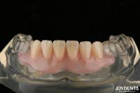 Personalized Invisible Denture Finished With Advanced Tooth Arrangement Technology