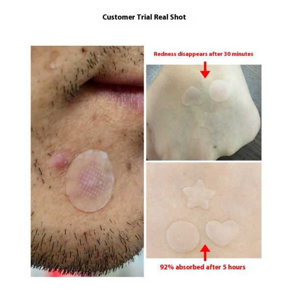 Single Sided Painless Microneedle Acne Patch Microcrystals Water Activated PE Adhesive Sticker for Masking Use