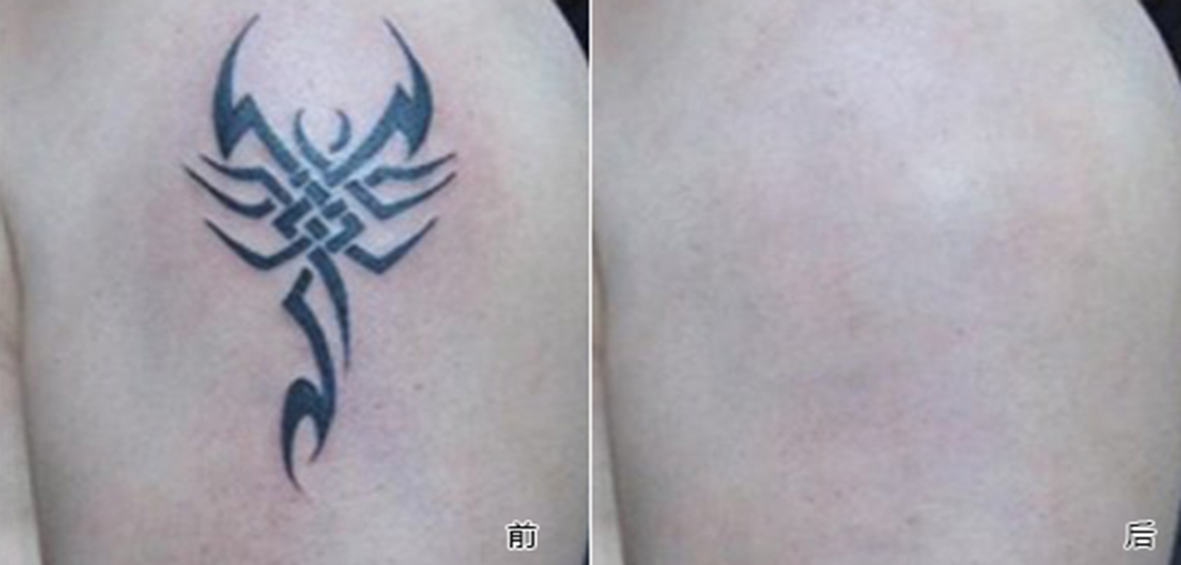 Female Beauty Salon Portable Q Switched Yag Laser For Hyper pigmentation