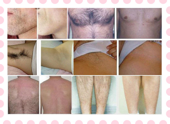 Medical 808nm Diode Laser Hair Removal Machine , Skin Tightening Equipment