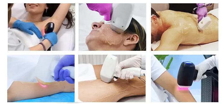 755nm 808nm 1064nm Diode Laser Epilator Hair Removal Machine Permanent Painless