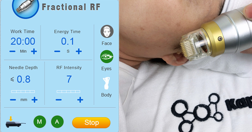 машина частичной RF глубокой жары 4 рук красоты Microneedling лицевая