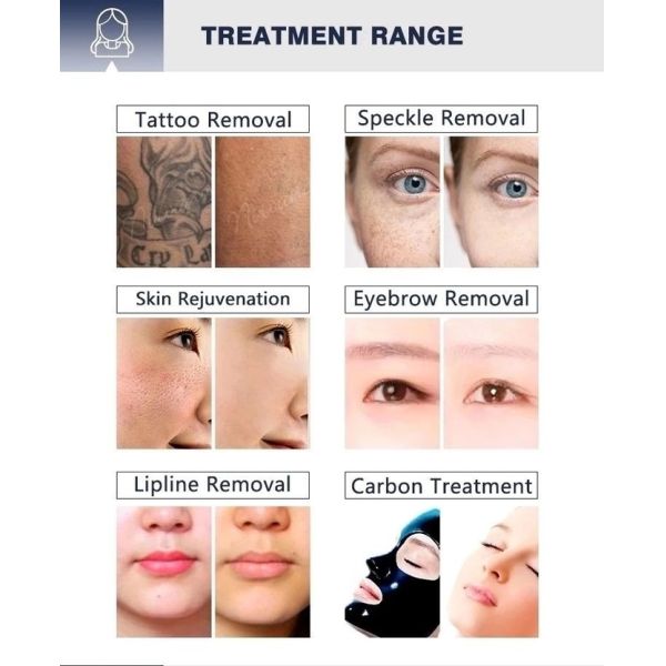 2000W q переключило машину корки углерода машины 1320nm лазера ND YAG