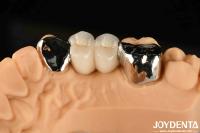 Métallique Dental Maryland Bonded Bridge Bon remède pour la réparation clinique orale
