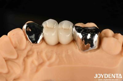 Metallic Dental Maryland Bonded Bridge Good Remediation For Oral Clinical Repair