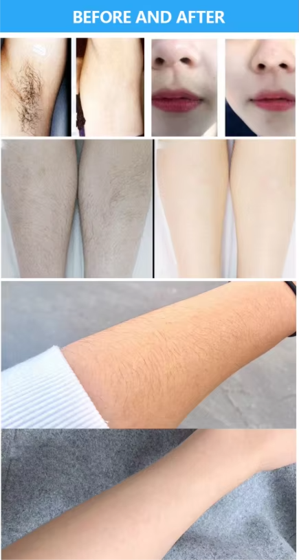 Dual Handles 808nm Diode Laser Hair Removal and Picosecond Laser Tattoo Removal Machine 2in1