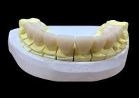 Coroa dental de porcelana de zircônio com acabamento estético e de aparência natural do laboratório dentário da China