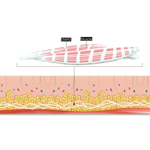 Home Use Portable American HIFU Facelift Machine skin lifting