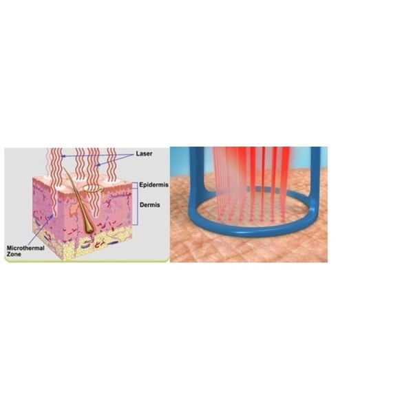 CO2 Fractional Laser Machine for Skin Resurfacing and Scar Removal Transform Your Skin