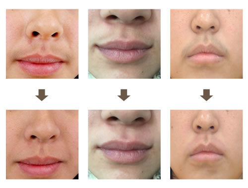 Лазер диода разделяет ручку удаления волос лазера длин волн 755нм/810нм/1064нм