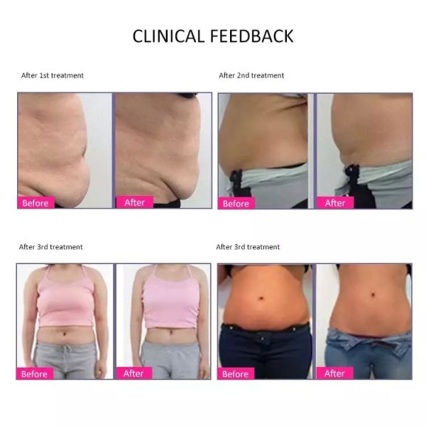 360 Angle Surrounding 40k Cryolipolysis Slimming Machine