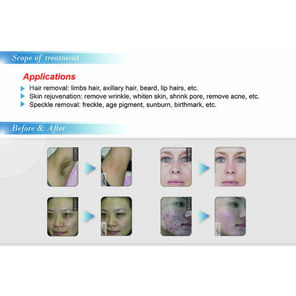 clinic owner SHR Fast Hair Removal/Skin Rejuvenation Unit NBW-SHR212