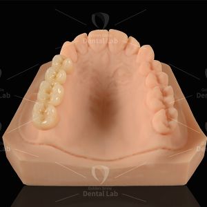 Zirconia Restorations
