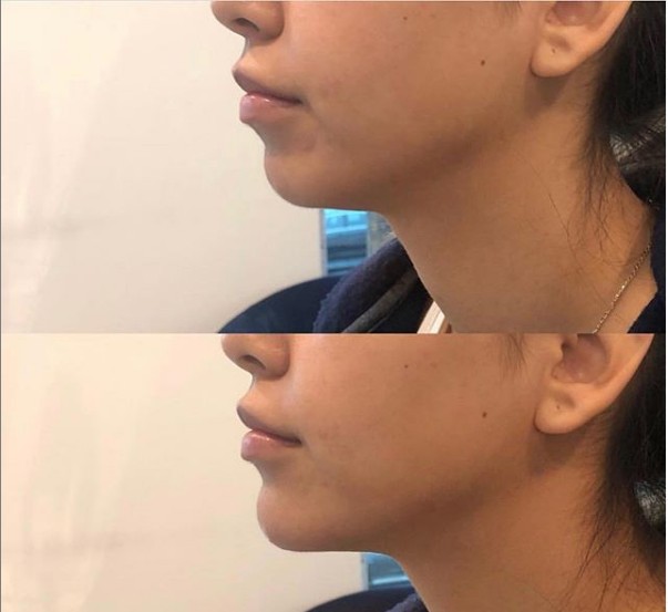 Морщинок заполнителя Juvederm Ultra4 24mg/Ml впрыска дермальных анти- Hyaluronic кисловочная