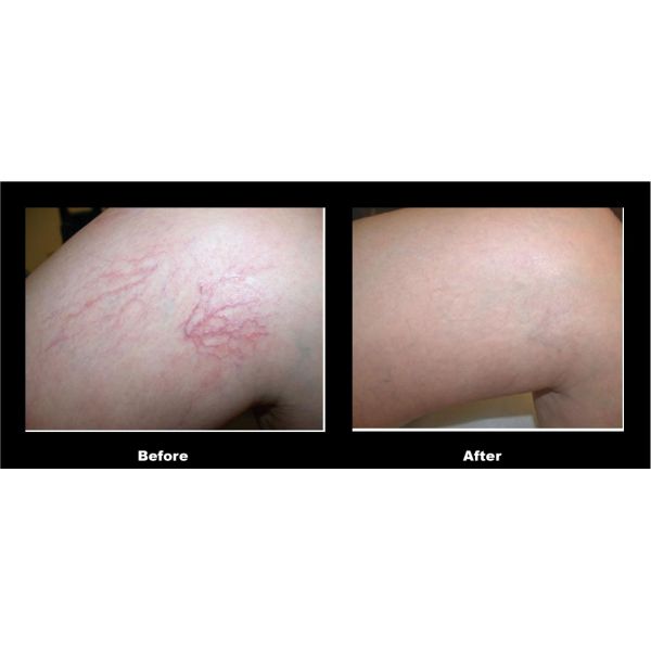 painful varicose veins treatment prices for spider veins on face removal with 0.01mm needle hot
