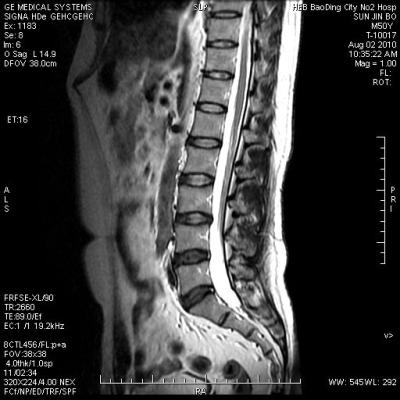 Umidade - filme seco médico rígido 8in x 10in de X Ray da prova para a impressora térmica