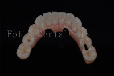Natural Looking All On Four Teeth In A Day For Any Age Available